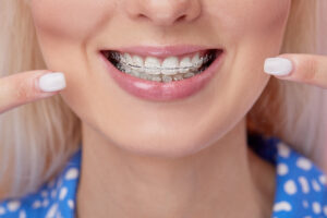 Can Clear Braces Stain from Coffee, Tea, or Wine?