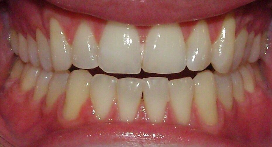 Before