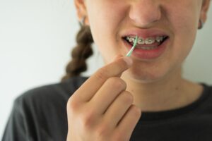 Can You Chew Gum With Braces? What San Diego Orthodontists Recommend